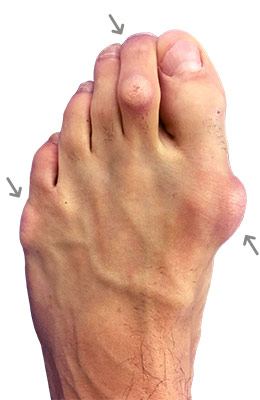 Lapidus Forever Bunionectomy™ and Hammertoe Correction before