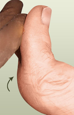 Hallux Limitus Correction after