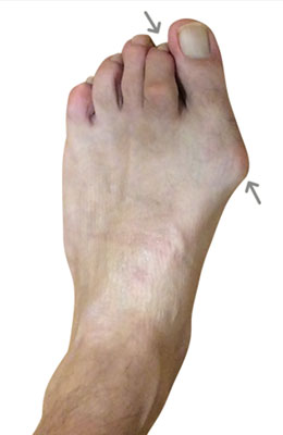 Lapidus Forever Bunionectomy™ and Hammertoe Correction before