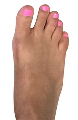 Lapidus Forever Bunionectomy™ with Hammertoe Correction after