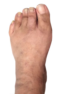 Osteotomy Bunionectomy after