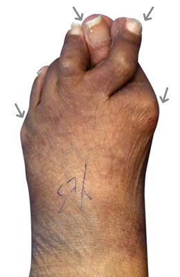 Lapidus Forever Bunionectomy™ and Hammertoe Correction with Tailor's Bunionectomy before