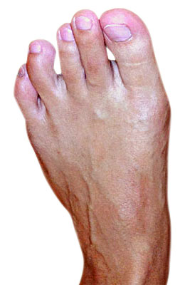 Bunion Surgery (Osteotomy Bunionectomy) after