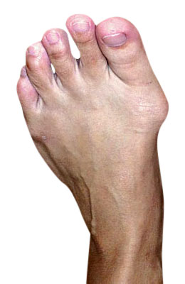 Bunion Surgery (Osteotomy Bunionectomy) before