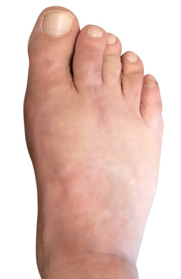 Bunionectomy and Plantar Plate Repair after