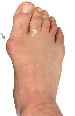 Bunionectomy and Plantar Plate Repair before