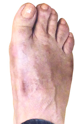 Lapidus Forever Bunionectomy™ and Neuroma Removal after