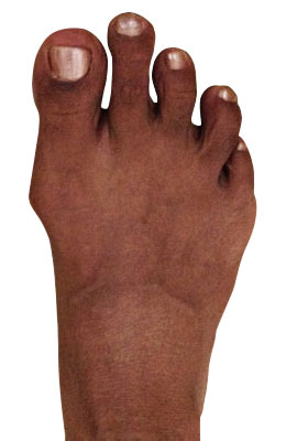 Lapidus Forever Bunionectomy™, Hammertoe Correction, Osteotomy Tailors Bunion Surgery before