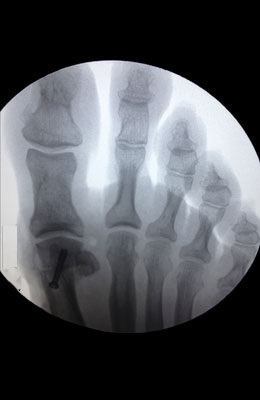 Osteotomy Bunionectomy after