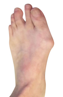 Lapidus Forever Bunionectomy™ Bunion Surgery before