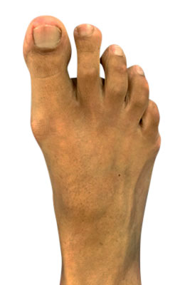 Osteotomy Bunionectomy and Osteotomy Tailors Bunionectomy before