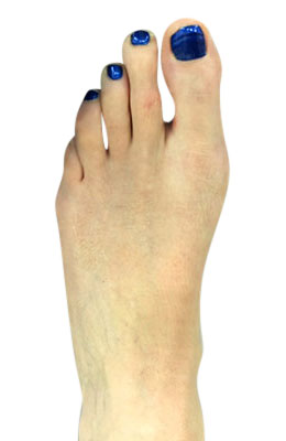 Minimally Invasive Bunion Surgery featuring the CrossRoads miniBunion™ System after
