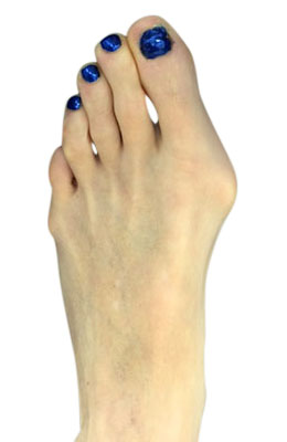 Minimally Invasive Bunion Surgery featuring the CrossRoads miniBunion™ System before