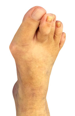 Osteotomy Bunionectomy and Plantar Plate Repair before