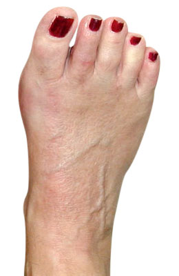 miniBunion™ Minimally Invasive Bunion Surgery, Hammertoe Correction and Plantar Plate Repair after