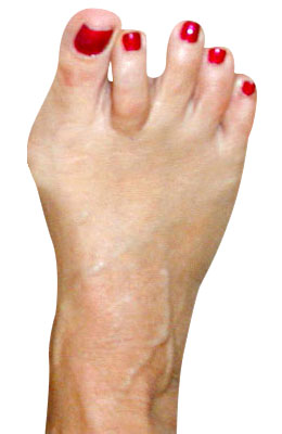 miniBunion™ Minimally Invasive Bunion Surgery, Hammertoe Correction and Plantar Plate Repair before