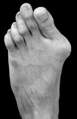 Lapidus Forever Bunionectomy™, Hammertoe Correction 5th Intermediate before