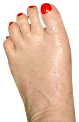 Osteotomy Bunionectomy after