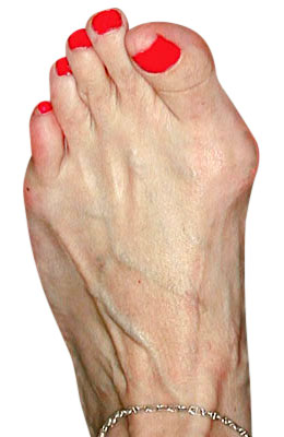 Osteotomy Bunion Surgery before
