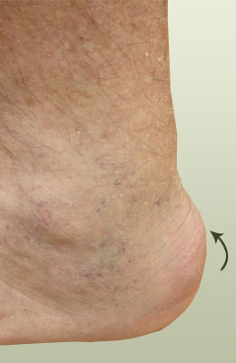 Achilles Spur Surgery before
