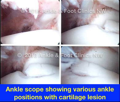 Ankle Arthroscopy