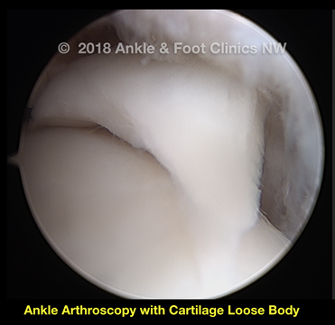 Ankle Arthroscopy