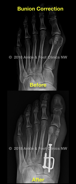 Bunion Surgery