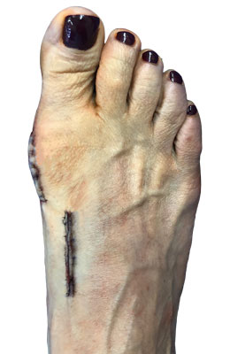 Lapidus Forever Bunionectomy™ and Hamertoe Correction after
