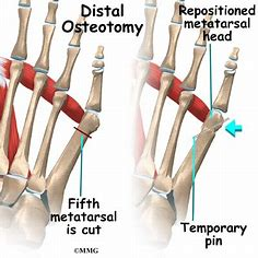 Do I Have a Bunionette on My Pinky Toe