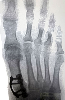 Lapiplasty Bunion Surgery after