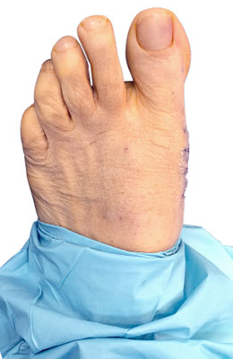 Osteotomy Bunionectomy after