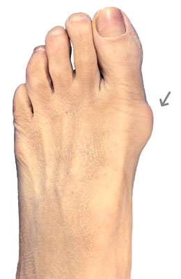 Osteotomy Bunionectomy before