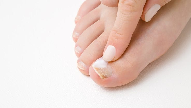 Custom Fungal Nail Soaks from expert podiatrists