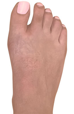 Lapidus Forever Bunionectomy™ after image