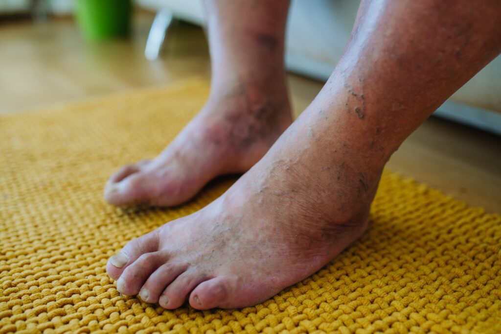 Diabetic Foot Care - Diabetic Wounds