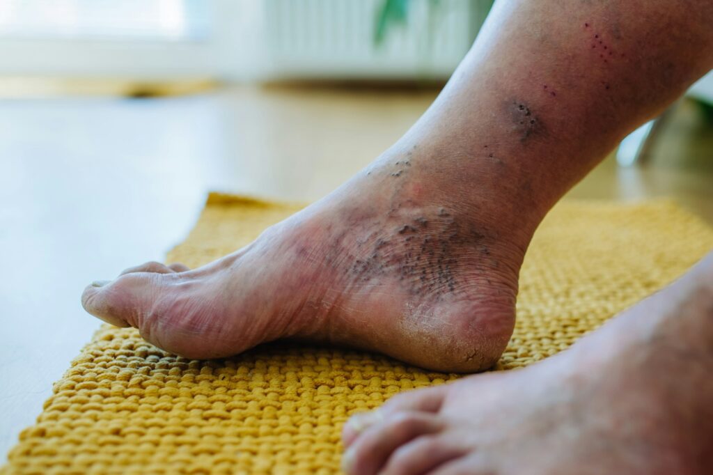 Neuropathy - Attention Diabetic Patients: Healthy Habits to Prevent problems - Foot Ulcers