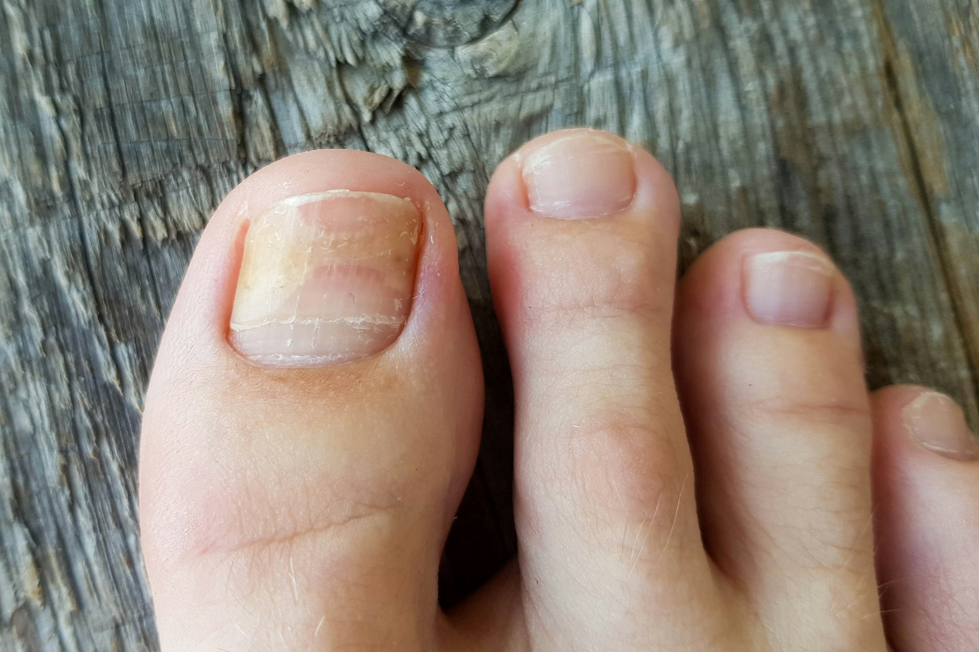 Toenail Fungus - fungus on toenails