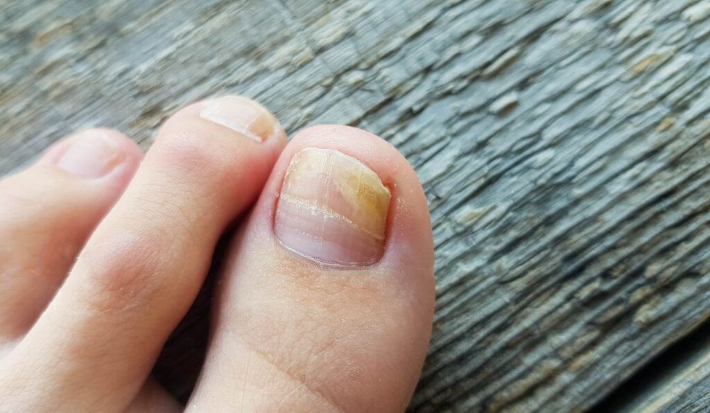 Toenail Fungus