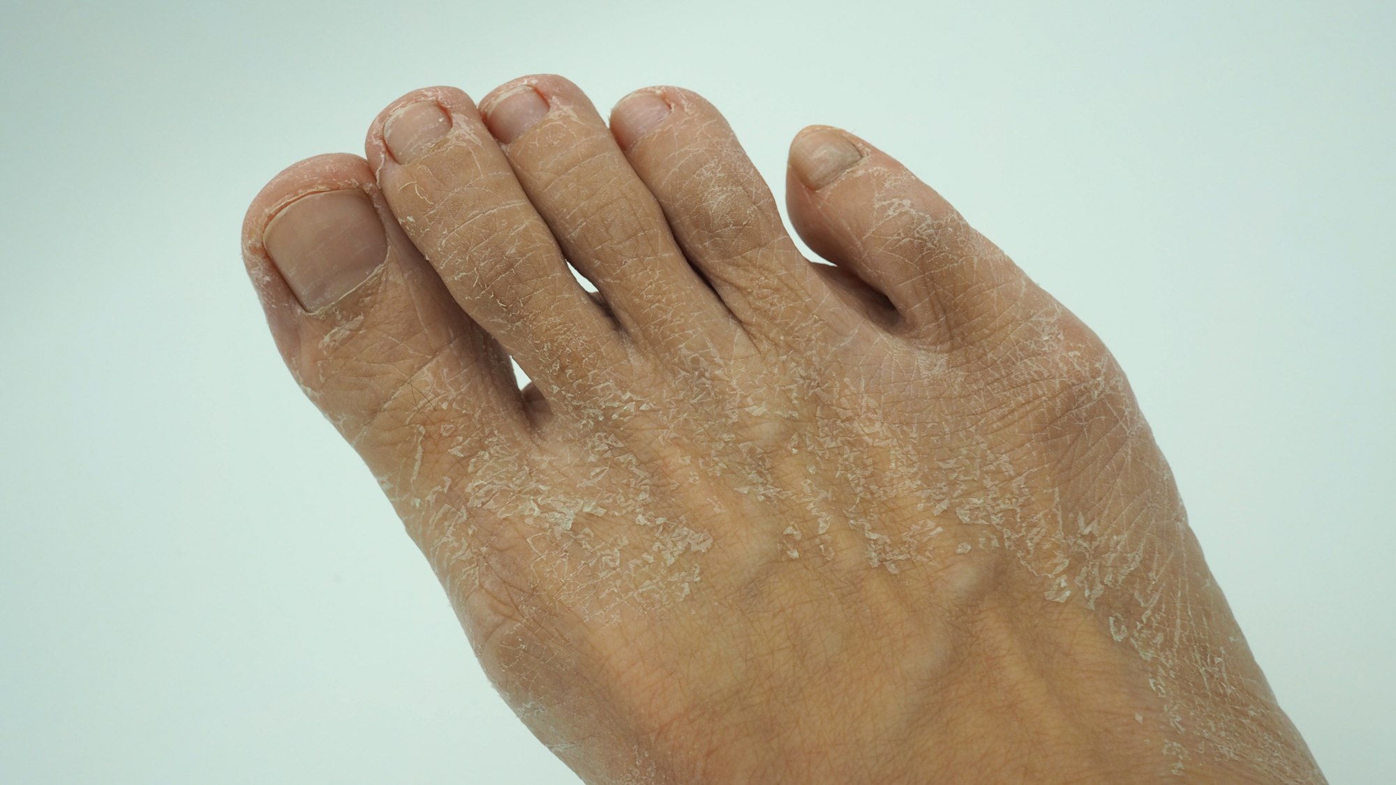 Why is the skin on my feet so dry and flaky?