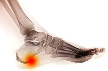 Heel Spur