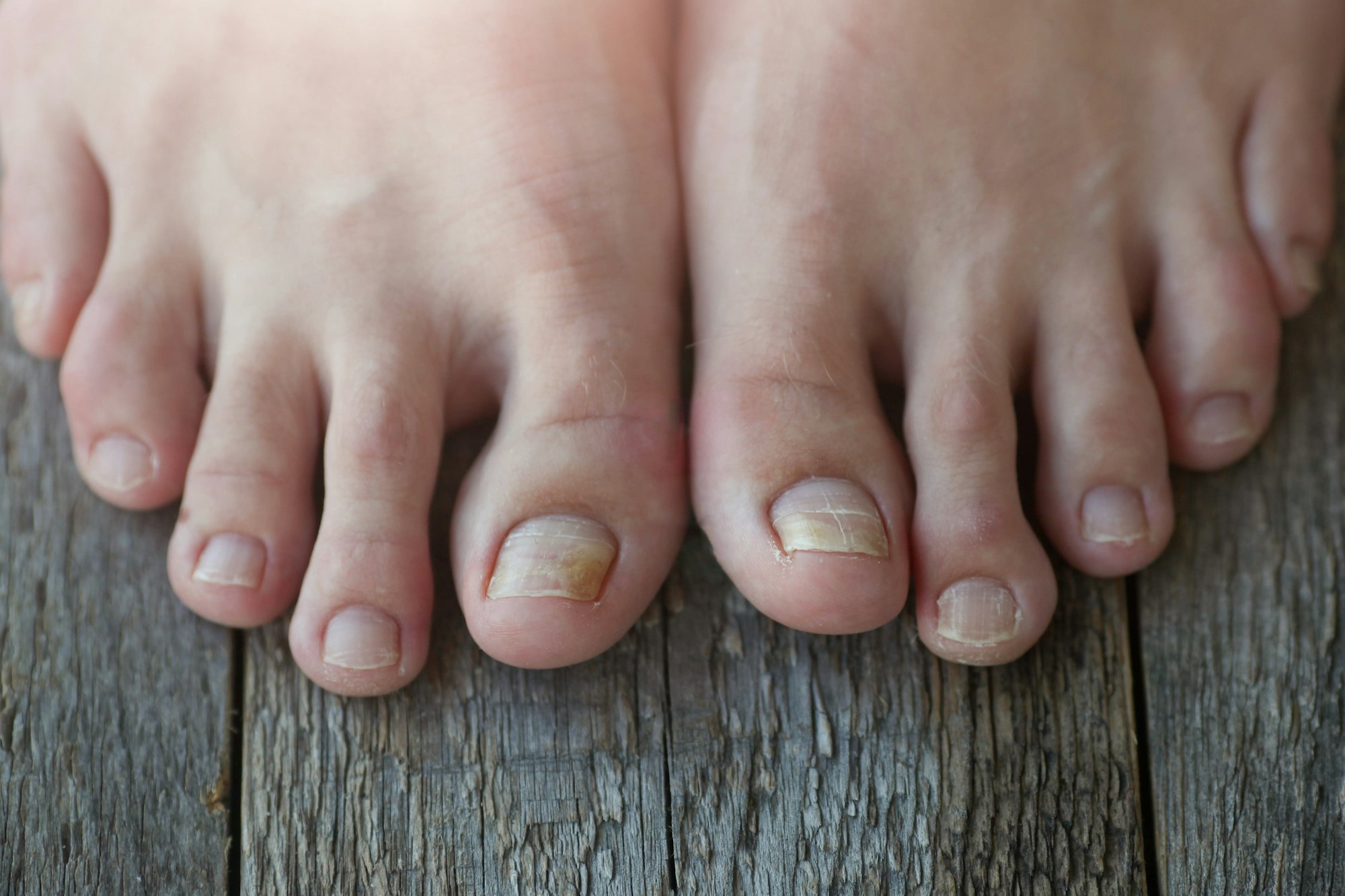 Why Are My Toenails So Ugly? Could It Be A Fungal Nail?