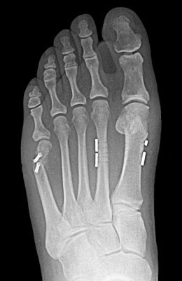 Tightrope Procedure and Osteotomy Tailors Bunion Surgery after